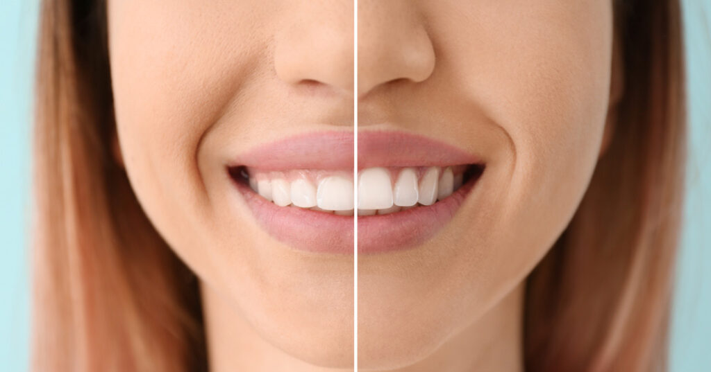 gingival plasty