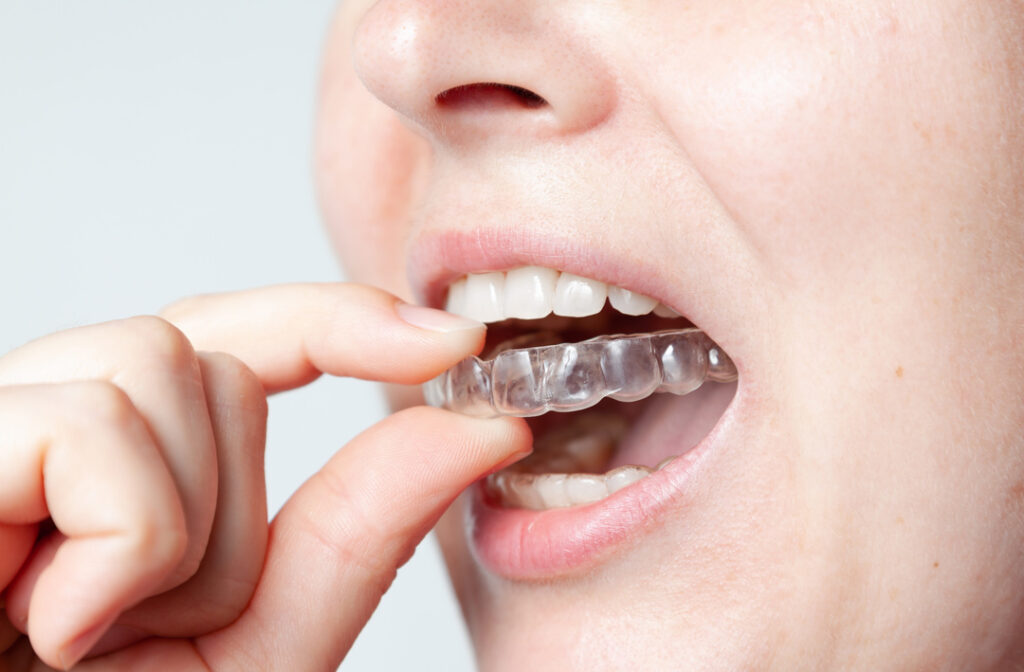 Caps for teeth after braces hold bite in desired position....