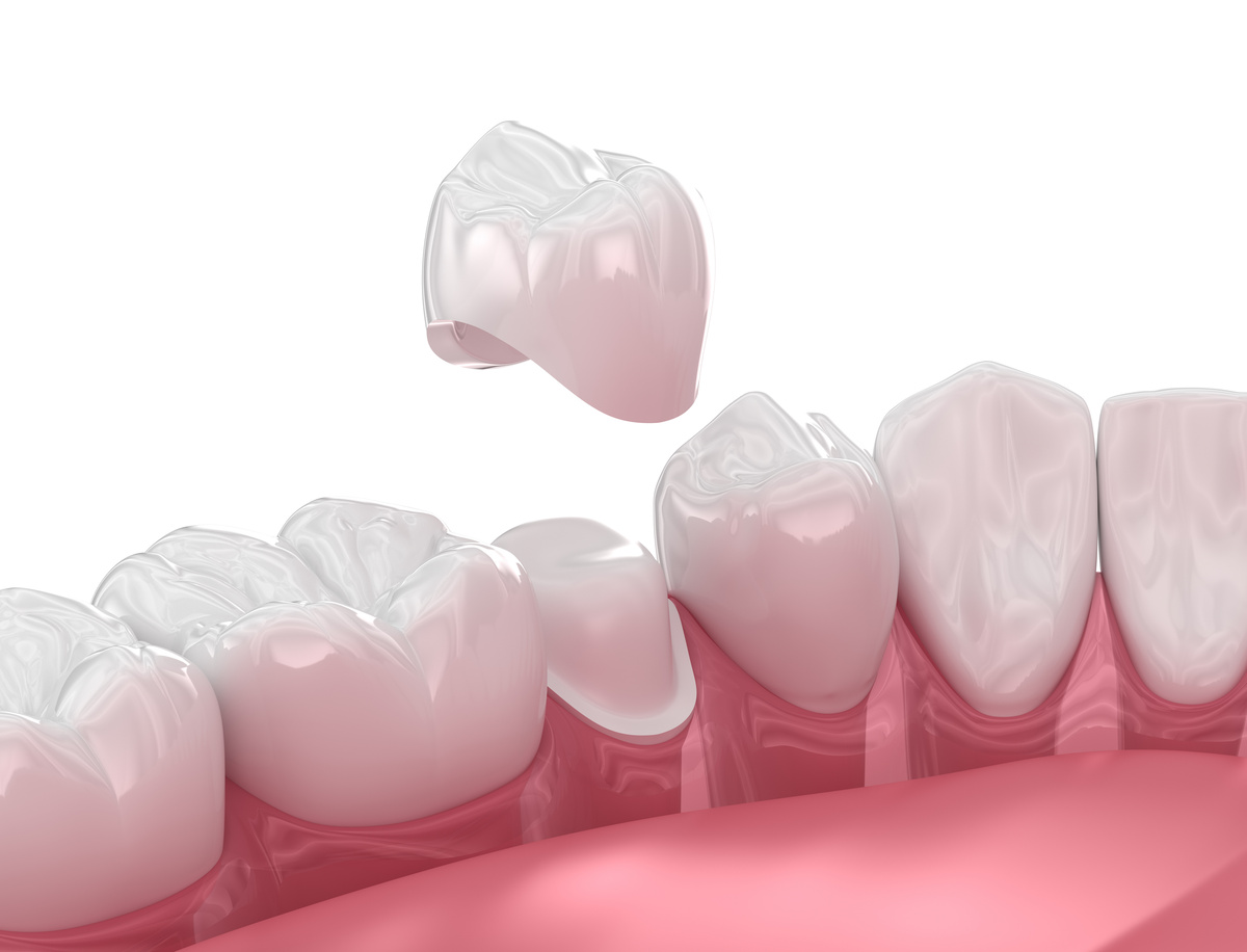 Same-Day Crowns vs. Traditional Crowns | Floss & Co. Blog