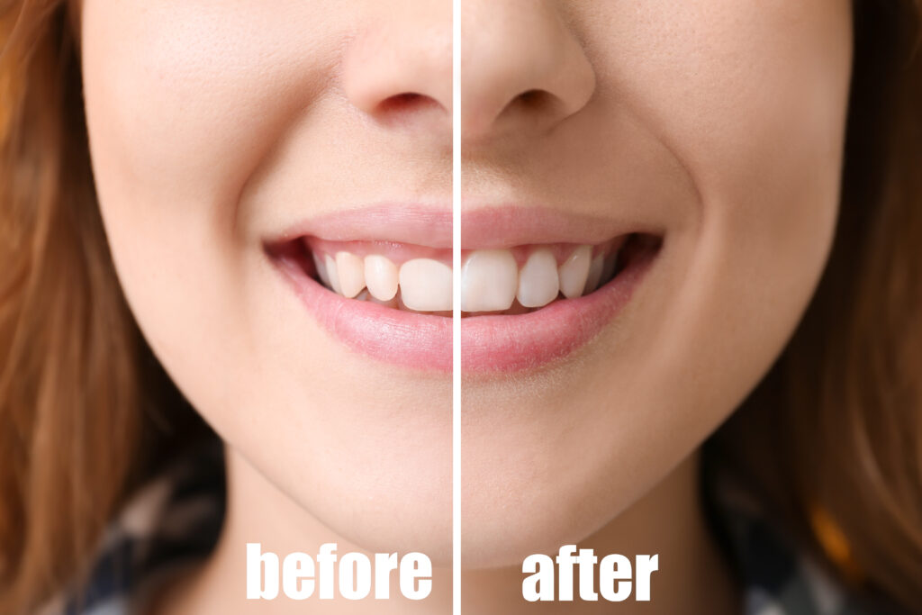 Young woman before and after gum contouring gingival plasty procedure closeup